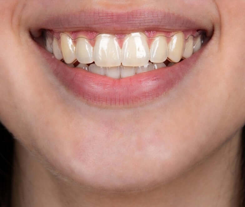 FENLE Clear Aligners: Why Removable Dental Appliances Make Structural Sense - smiling person wearing clear aligners.